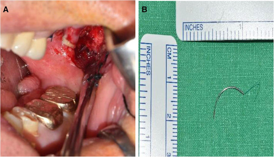 Side-by-side photo of needle fragment lodged in the buccal mucosa and the retrieved needle.