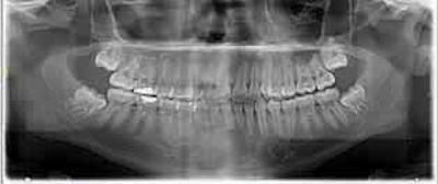 A panoramic radiograph shows the restoration of tooth #3 with periapical radiolucency and right maxillary sinusitis