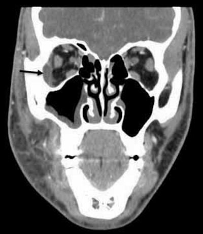 A CT scan (coronal section) shows the patient