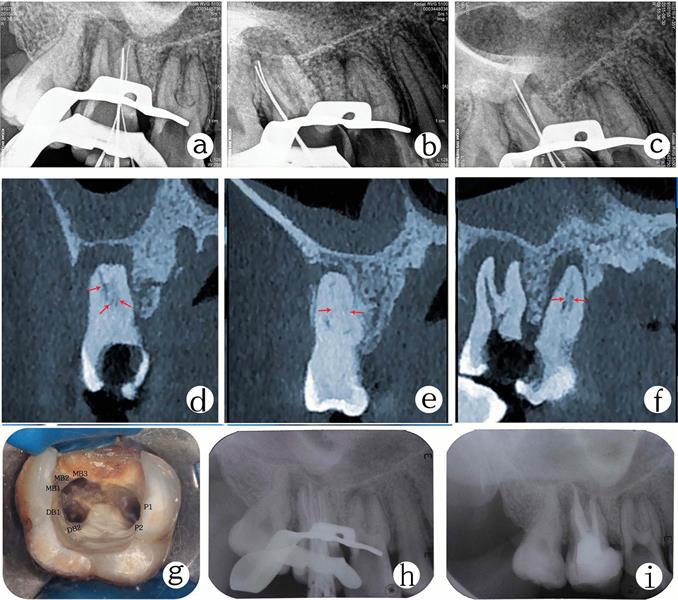 X-ray of tooth #17 shows mesiobuccal, distobuccal, and palatal roots. A CBCT scan shows canal configuration in the mesiobuccal root, distobuccal root, and palatal root canals. Image of root canal orifices. Image of master cone fit. Postobturation radiograph.
