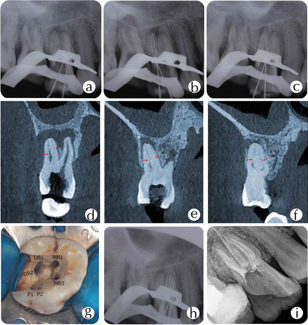 X-ray of tooth #16 shows mesiobuccal, distobuccal, and palatal roots. A CBCT scan shows canal configuration in the mesiobuccal root, distobuccal root, and palatal root canals. Image of access opening showing six root canal orifices. Image of master cone fit. Postobturation radiograph.