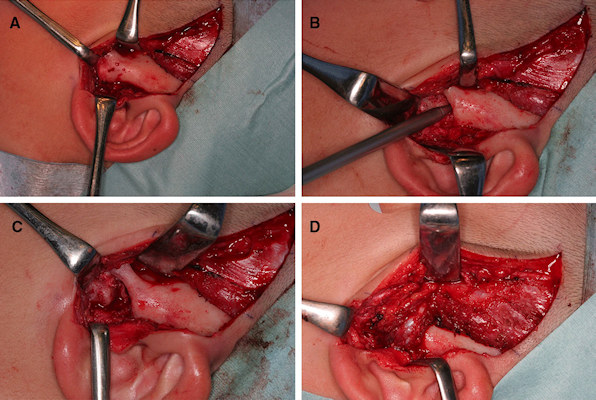 Intraoperative photos demonstrating a bony fusion between the condylar head and glenoid fossa, the use of the navigation system to confirm the operating position, the formed articular cavity, and the temporal muscle insertion into the joint space created by the surgery