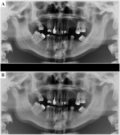 Panoramic radiographs of an anthropomorphic phantom covered with a soft-tissue simulator acquired with the use of a face mask with a nose wire and one without a nose wire