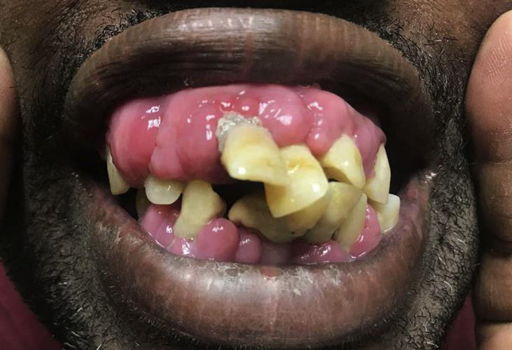 The patient showing amlodipine-induced gingival overgrowth