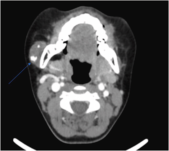 An axial CT with contrast image reveals a lesion in the 12-year-old