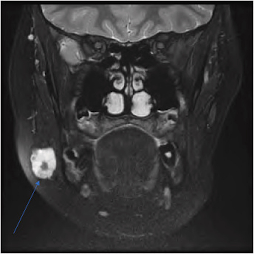 An arrow labels a well-circumscribed, T2 hyperintense lesion on a coronal T2 MRI neck scan