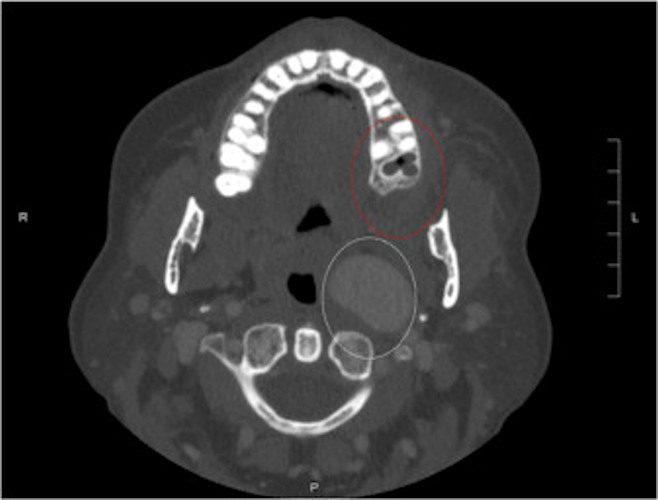 An axial CT scan of the patient