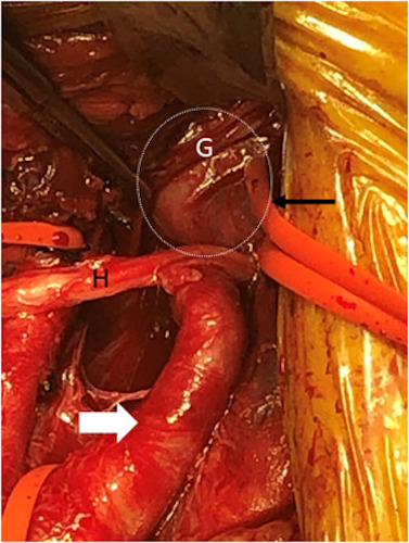 A perioperative image of the proximal (white arrow) and distal (black arrow) ICA with the aneurysm identified in the dotted white circle