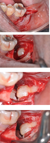 Clinical images taken during surgical removal of the patient