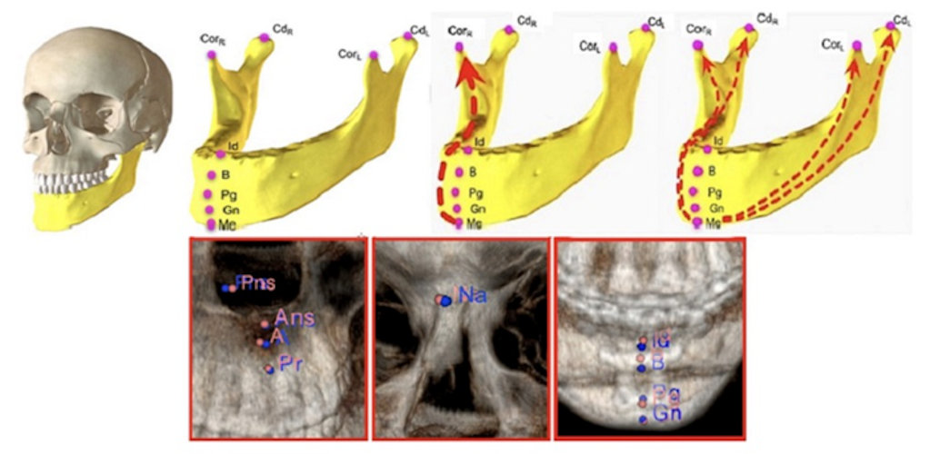 A deep-learning model analyzed CT images to reveal the spatial relationships between key anatomical landmarks of craniomaxillofacial bones
