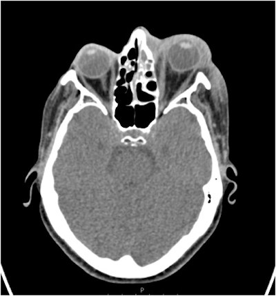 An axial CT scan shows significant preseptal swelling and post septal/retro-orbital fat stranding with small volume fluid at the lateral and superior left orbit.