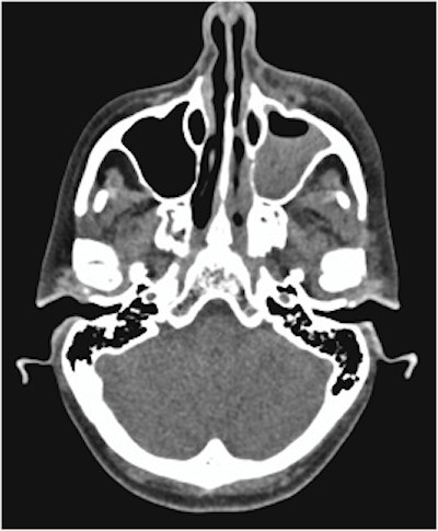 An axial CT scan shows opacification of the woman