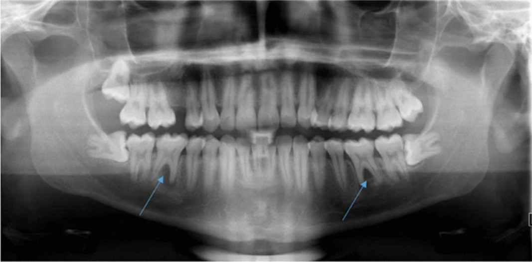 An x-ray taken in January 2020 shows apical and interradicular osteolysis on tooth #36 and #46.