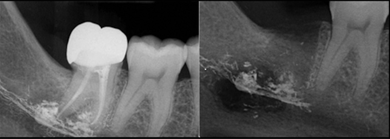 Dental x-ray showing apical radiolucency, with superimposed radiopaque sealer material extruding at the root tips of endodontically treated tooth #47