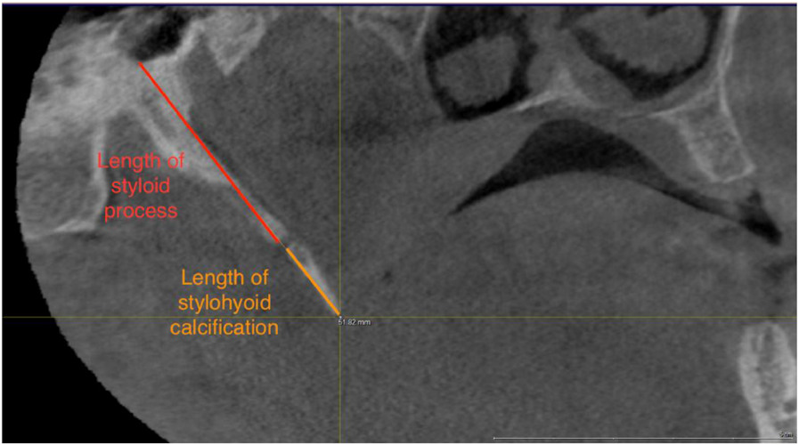 CBCT in the sagittal plane reveals the length of the styloid process and the length of the stylohyoid ligament calcification