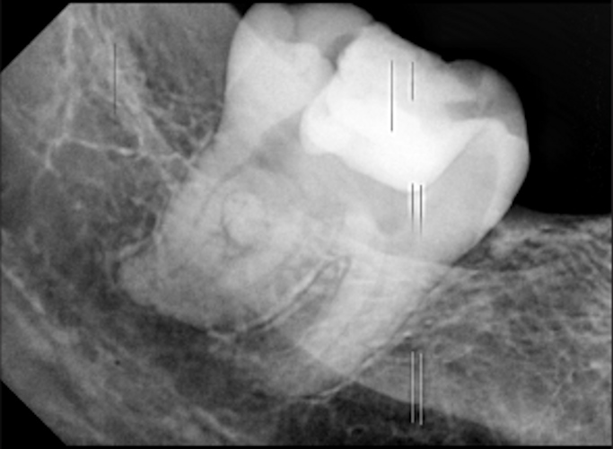An intraoral x-ray of the patient
