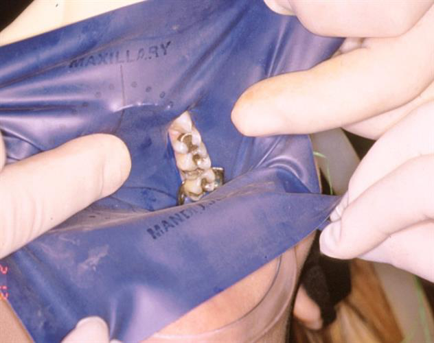 Place a rubber dam clamp on the most distal tooth in the quadrant.