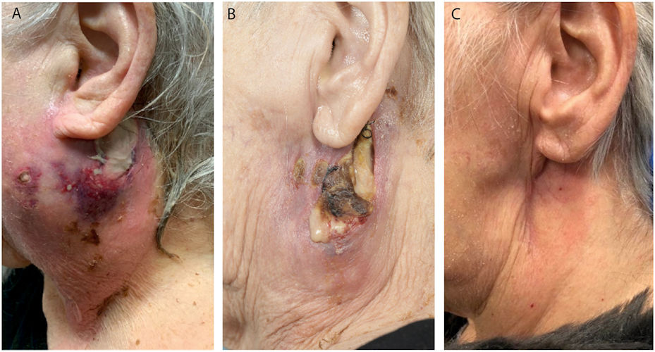 Images of a 75-year-old woman treated for a parotid abscess.