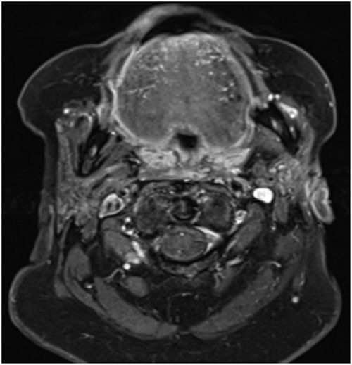 MRI of a healed parotid abscess.