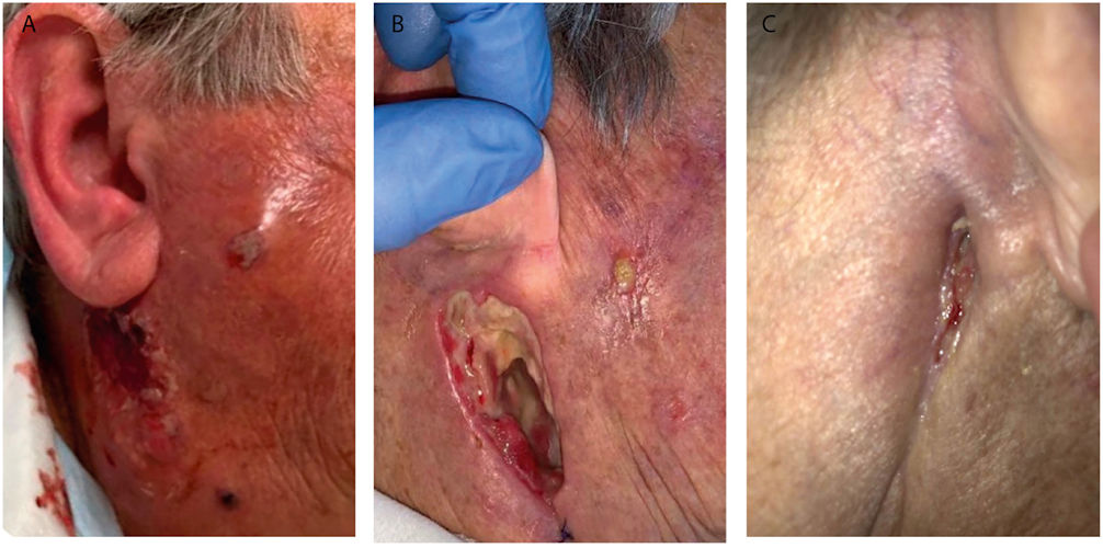 Image of an 81-year-old woman treated for a parotid abscess.