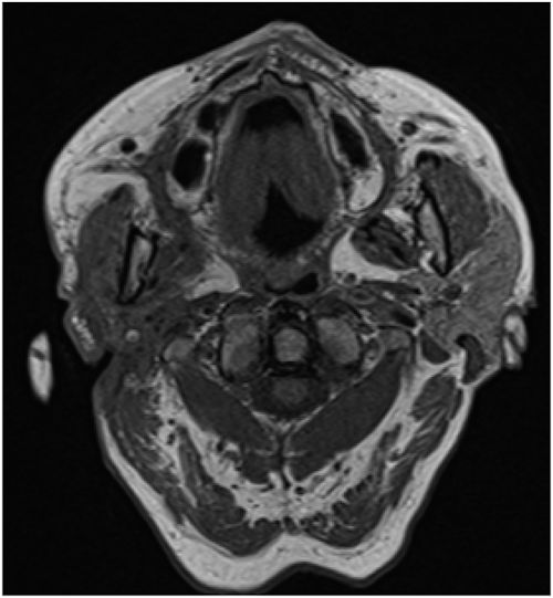 Follow-up MRI of a patient with a parotid abscess, which revealed no signs of malignancy.