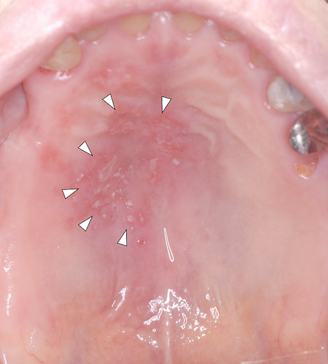 Photo of multiple unilateral herpes zoster on a patient