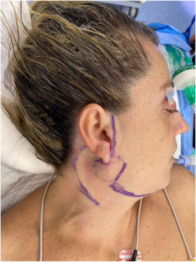 A patient with ultrasound gel applied to her hair to prevent hair from interfering with the surgical site
