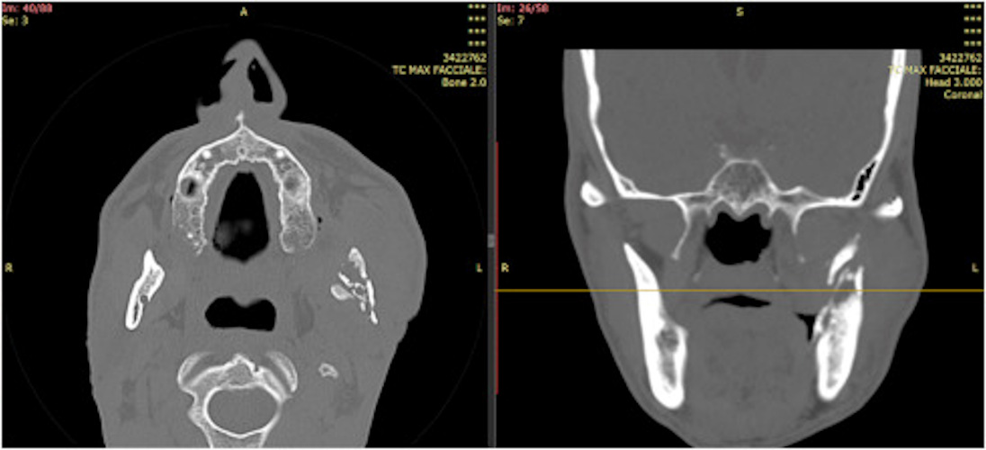 A CT scan revealed axial (a) and coronal (b) sections showing aseptic necrosis of the ramus mandible