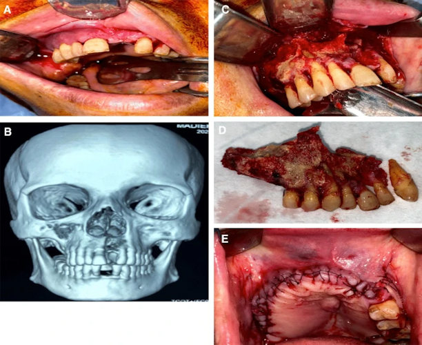 Images demonstrating cases of post-COVID-19-related osteonecrosis of the jaw