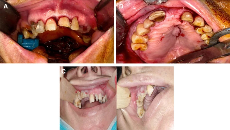 A variant clinical picture, which may be present in patients with post-COVID-19-related osteonecrosis of the jaw. A. Image of a mobile dentoalveolar maxillary segment with intact mucosal bone coverage. B. Image of palatal swelling. C. Image of mucosal ulceration and exposed necrotic bone