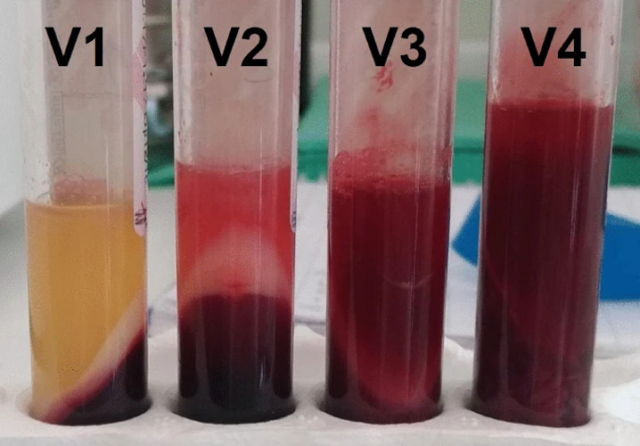 Adding vancomycin resulted in substantial changes in physical properties or no PRF formation.