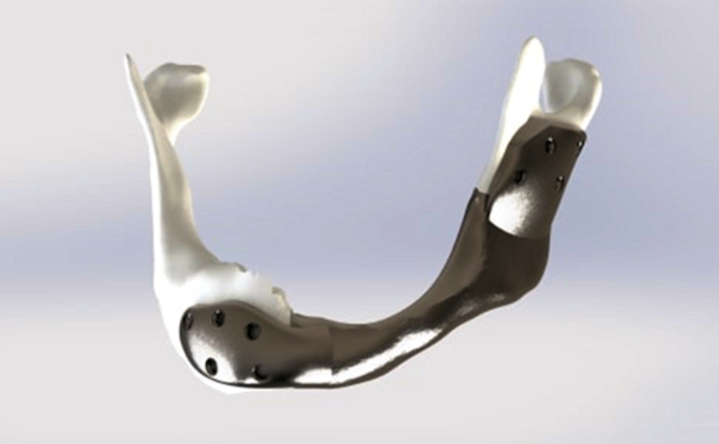 The Netherlands Cancer Institute successfully carried out the first operation with a custom 3D-printed titanium lower jaw