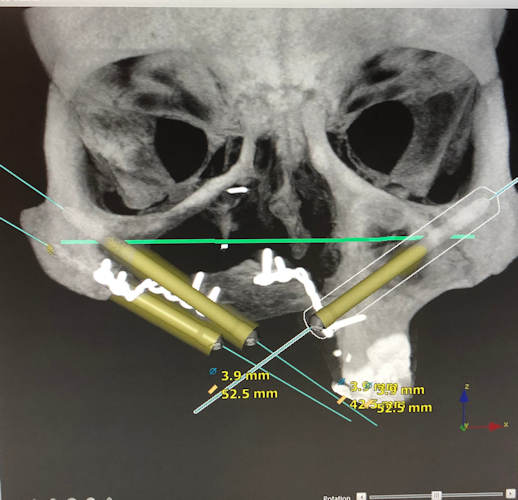 Imaging was used to help treatment plan the placement of Taylor