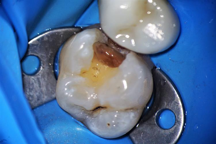Preparation of tooth #14 after amalgam and decay removal