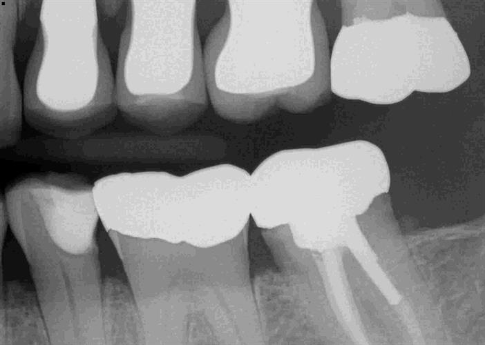 Preop radiograph of tooth #20