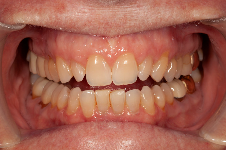 Preop retracted view before whitening